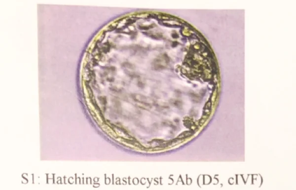 一颗完美的冻胚胎🤣🤣香港IVF日记😛,试管婴儿要代孕吗-正规的代孕妈妈公司