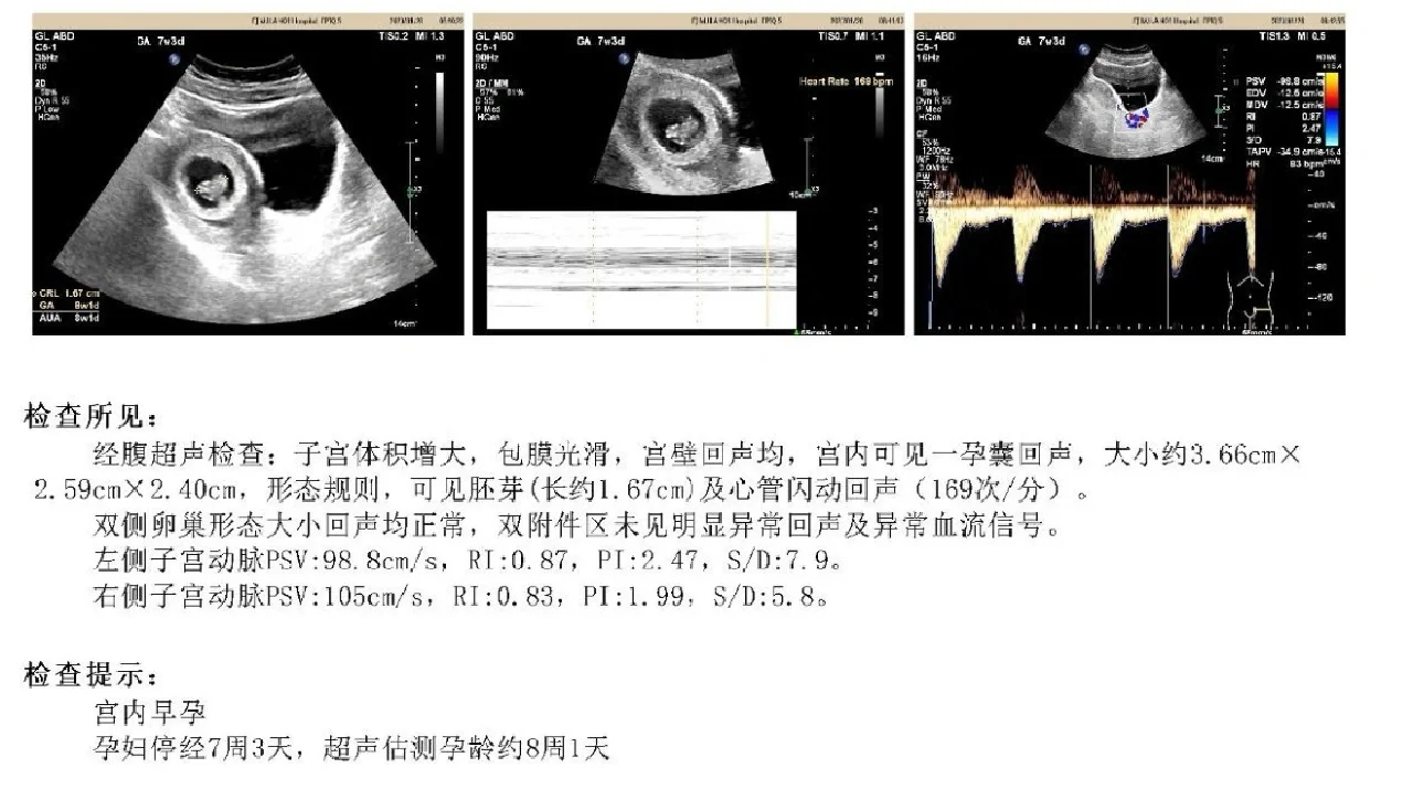 原发性闭经，低促，迎来了我的小兔崽～,代孕多囊卵巢&国内代生哪里找