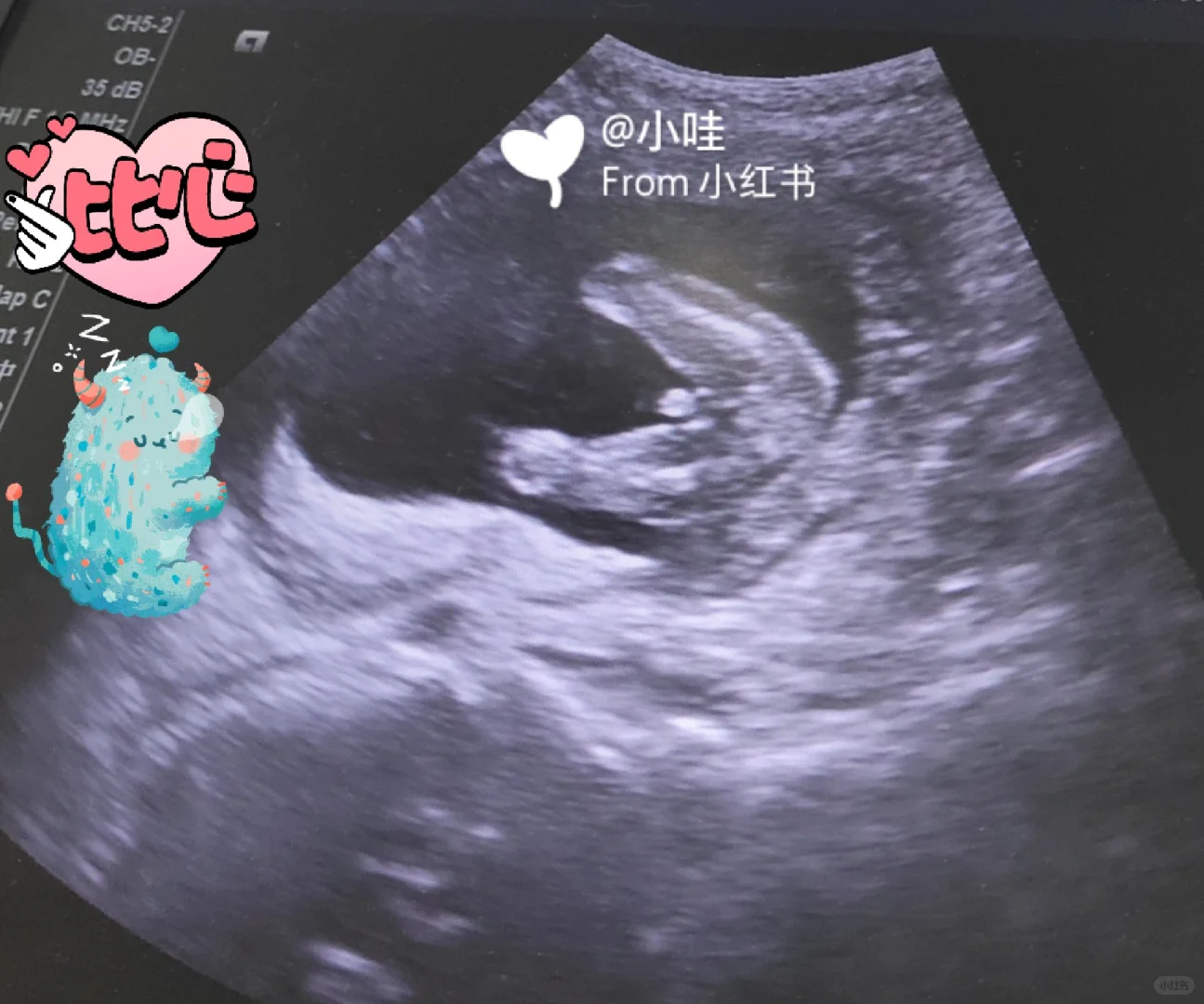 首图看得懂的进😜附:左心室强光点?😑,国内供卵试管哪里好一点&有真正可靠的代孕公司吗